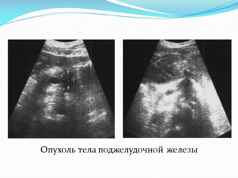 Опухоль тела поджелудочной железы